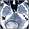 Intracerebellar hemorrhage - CT scan