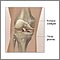 Knee joint replacement - Series