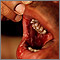 Pemphigus, vulgaris - lesions in the mouth